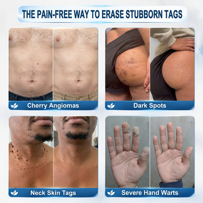 𝐇𝐞𝐚𝐥𝒓𝒊𝒛𝒆® 💃💃7-𝐃𝐚𝐲 𝐒𝐤𝐢𝐧 𝐓𝐚𝐠 & 𝐒𝐩𝐨𝐭 𝐄𝐫𝐚𝐬𝐞𝐫 𝐂𝐫𝐞𝐚𝐦 (Zero Pain, Zero 𝐒𝐜𝐚𝐫𝐬 Formula)